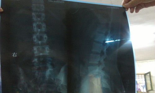 今天去拍x线,诊断为骶骨隐性裂,而且我问了两个骨科医师,他们看片后