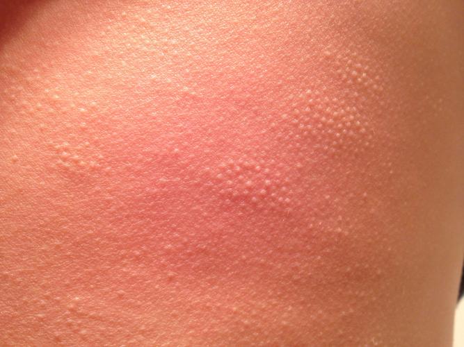 请教下皮肤科的医生,我儿子身上有许多这种小颗粒状的