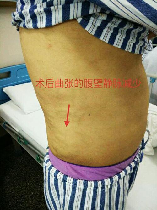 当"静脉曲张"遇上了"肝硬化",需高度怀疑"布加"!