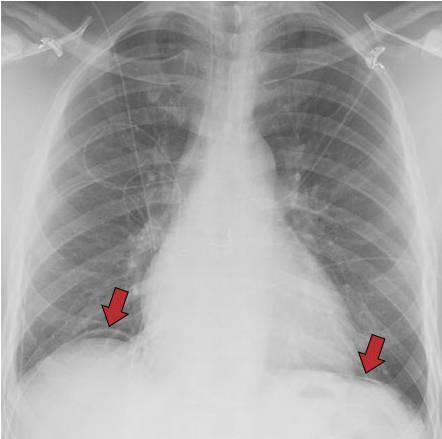 胸片上容易遗漏的15个细微异常