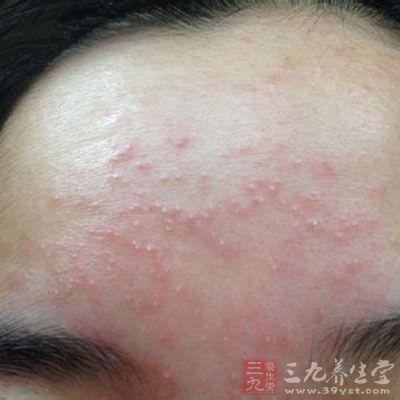 表现为面部的炎性丘疹,脓疱