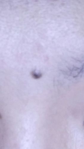 这是善痣还是恶痣