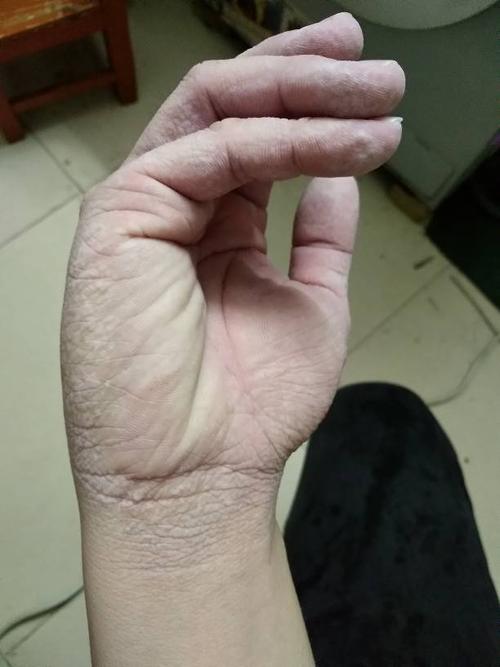 手这些地方,每到夏天这个炎热的季节,一泡水就起皱发白,有时出汗也会