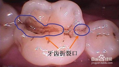 牙隐裂能洗牙吗?