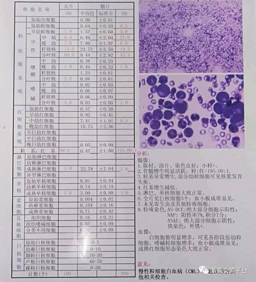 血小板减少性紫癜可以不做骨穿吗?