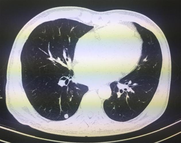 实性结节肺部ct影像,仅为举例,非正文所述案例