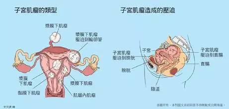 问答|子宫肌瘤是不是恶