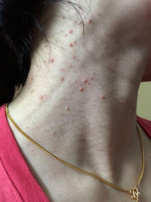 脖子上硬硬的红包.不痒,不疼.请问是什么?湿疹?皮炎