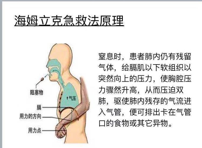 脊柱外科健康讲座之气道异物梗阻急救法