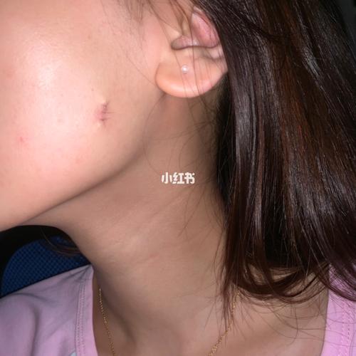 皮脂腺囊肿术后记录_猫耳朵_疤痕_清洁面部_豌豆_防晒