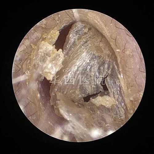 宝宝耳朵里的耳屎可以用挖耳勺取出来吗