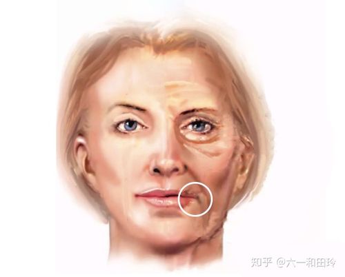 在一张图上对比更能看出口角囊袋的问题