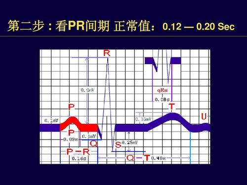 心电图幻灯片详解ppt