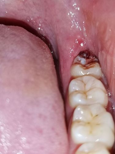 大夫说智齿位置长的正着呢,不用拔了,等消炎了把牙齿上盖的肉割了应该