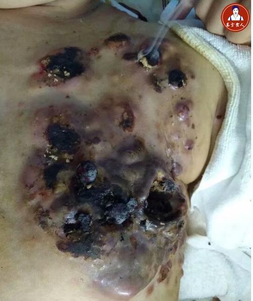 见鉴证晚期乳腺癌艾灸的过程(2)