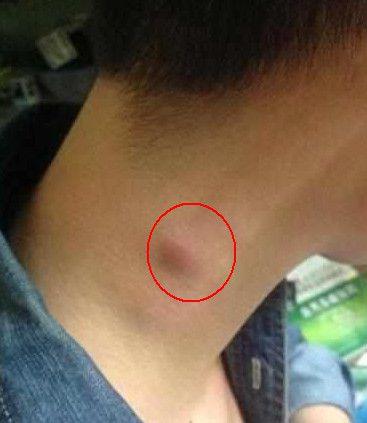 请注意脖子上长出这些小疙瘩是淋巴癌的早期表现