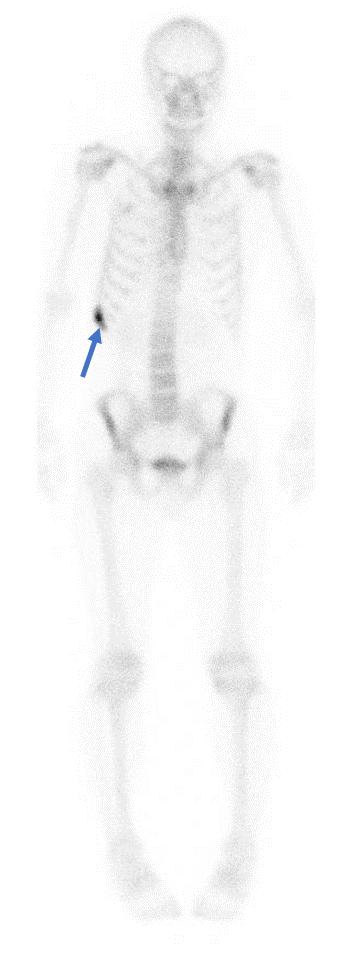 做肺部手术为什么要查骨扫描?骨扫描有问题怎么办,还能手术吗?