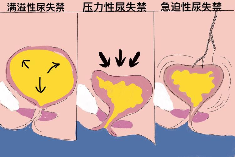 尤其是一些女性再加上生理原因,可能是会出现漏尿的问题,这是一个
