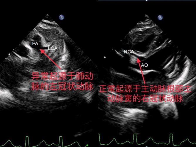 图1   术前心脏彩超明确诊断患儿左冠状动脉起源异常