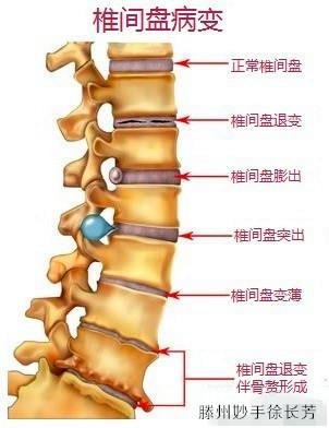 椎间盘膨出是椎间盘组织四向扩展超过了正常周边,纤维环并未破裂,主要