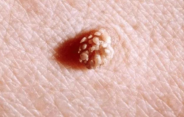 女性感染hpv之后,不只是身体会长疣体,月经出现这2种异常,也是在提醒