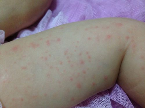 宝宝身上长的小红点点,是什麼?