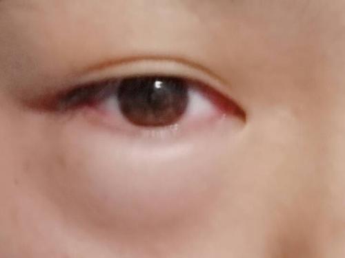 有鼻炎之类的过敏导致的病,以前就肿过眼睛,去医院说是血管性水肿,输