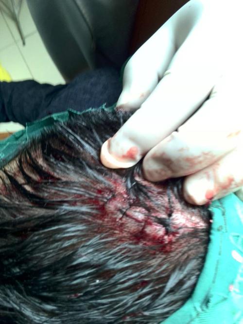 请问我头被人故意打破了,还砸碎我的汽车前挡风玻璃.