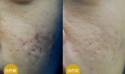 怎样快速祛除痘坑痘印痘疤