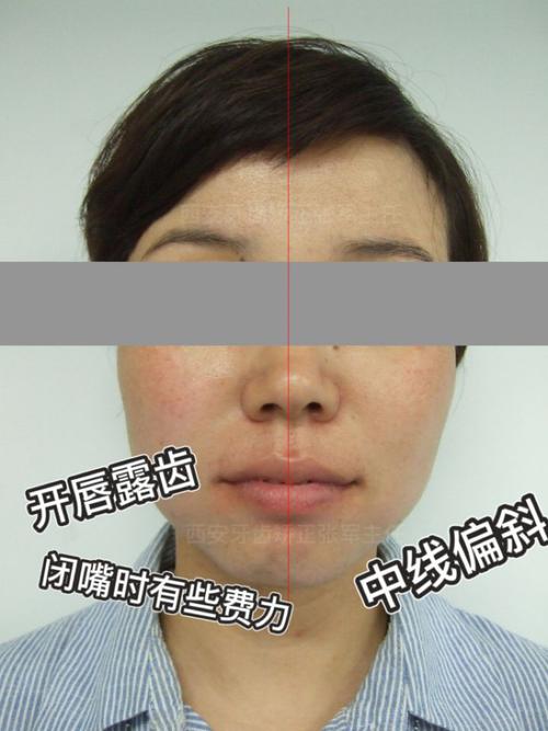 西安牙齿矫正凸嘴拉垮颜值侧颜凸嘴形象不满意怎么办