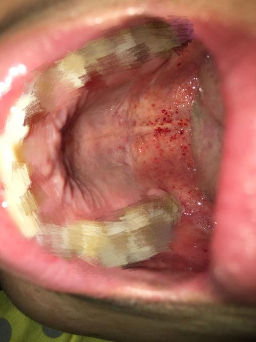 扁桃体发炎了.上颚起红色点是什么?