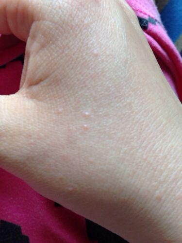 痒疹(prurigo)是一组以风团样丘疹,结节,奇痒为特征的瘙痒性炎症性