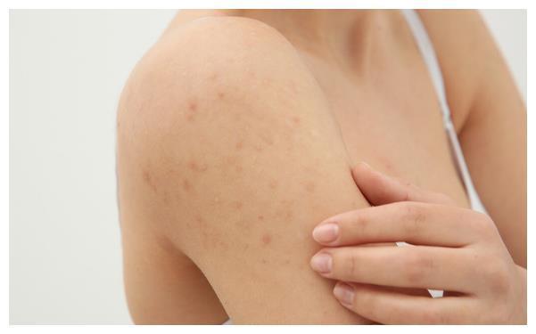 皮肤出现3种症状表现别总觉得是皮肤病可能是艾滋病来了