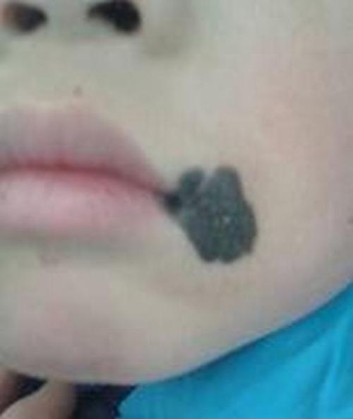 晕痣的具备哪些特点