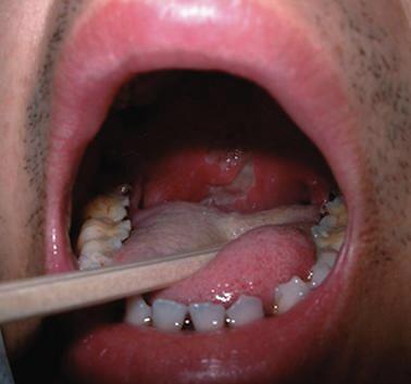 白塞氏病是一种全身性免疫系统疾病,同时或先后发生的口腔粘膜溃疡