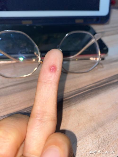 这到底是鸡眼还是疣还是血管瘤?