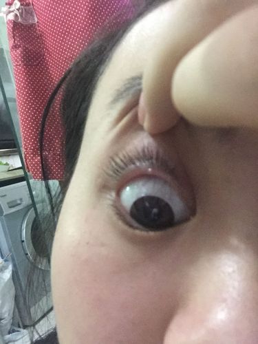 我右眼上眼帘那里长了一个透明白色小颗粒 这是什么该