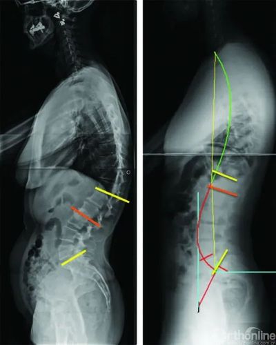 4改变顶点位置_从4种腰椎前凸临界点探寻腰椎退变过程