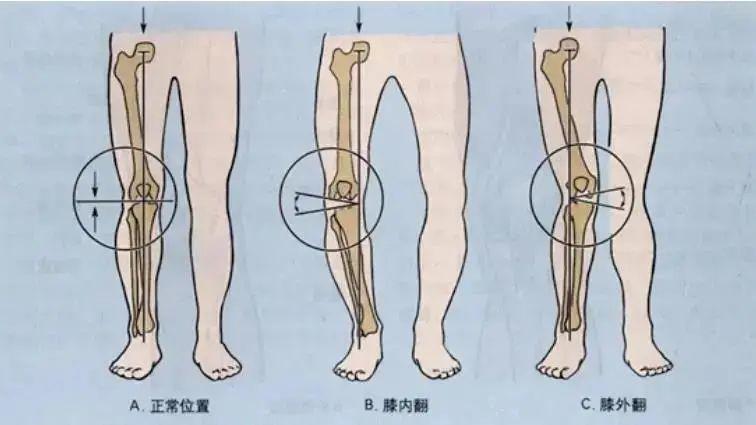 残疾预防|膝关节疼痛总是好不了怎么办?医生这样说