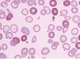 科普预防缺铁性贫血_红细胞