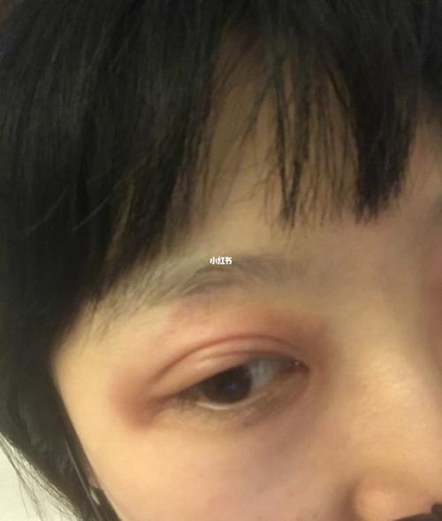 眼部过敏发炎成这样怎么见人
