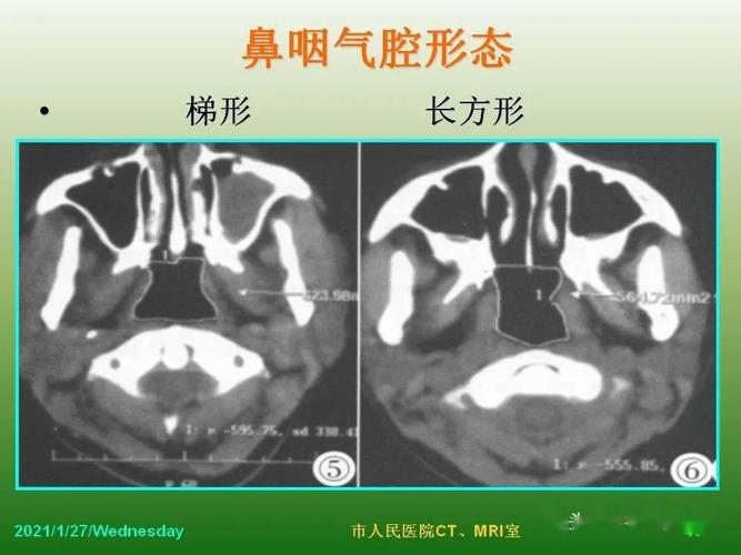 儿童腺样体肥大影像表现及诊断标准