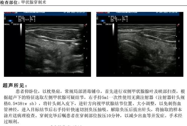 甲状腺细针穿刺活检