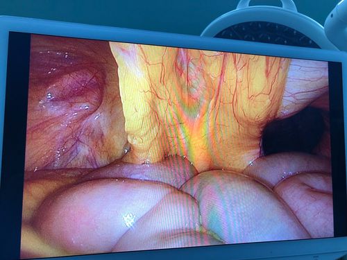 一例巨大阴囊疝tapp