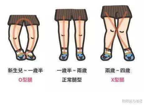 宝宝出现o型腿或x型腿,不是穿纸尿裤的缘故,真正的"元凶"是它