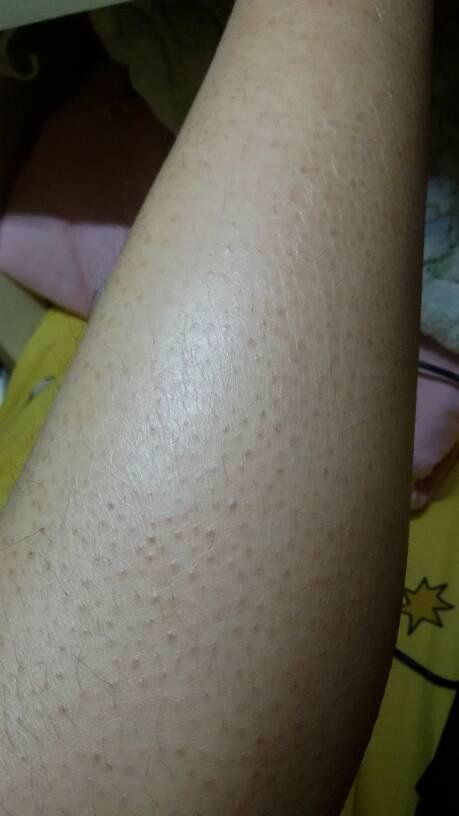 大概是毛周角化症,遗传病,好不了,只能尽量改善.