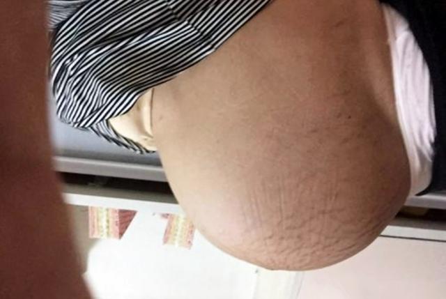 "悬浮肚"孕妈是什么体验?除了三种尴尬,还会遇到两重