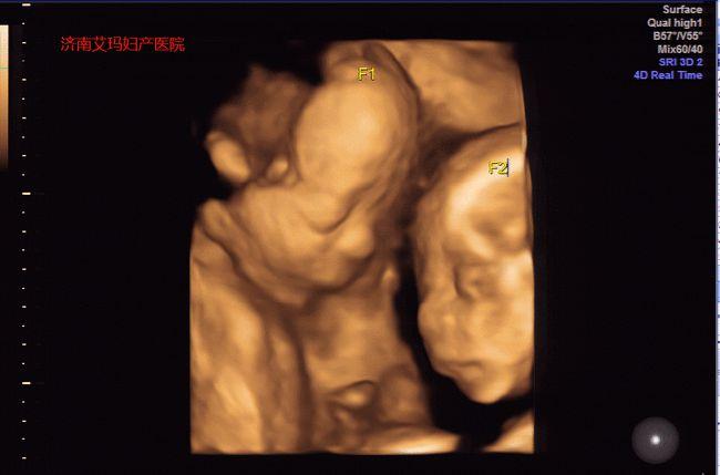 胎儿|羊水|彩超|孕妇_网易订阅