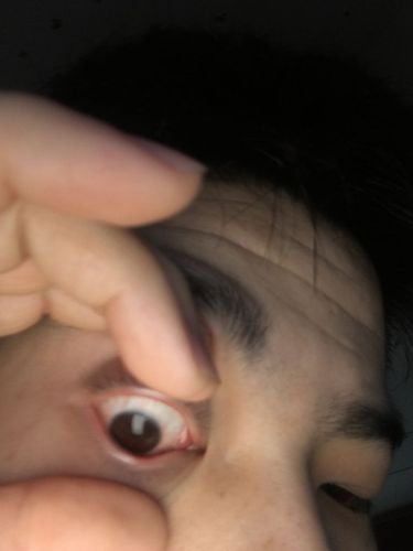 这个小眼角有长个肉膜粉粉的怎么办啊?