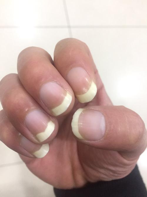 指甲发白!